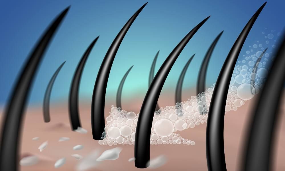 Home Remedies for Dandruff Cure